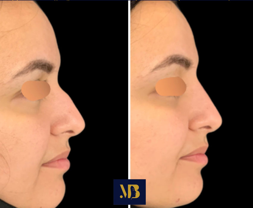 injection acide hyaluronique du visage permet de traiter la bosse du nez sans chirurgie.